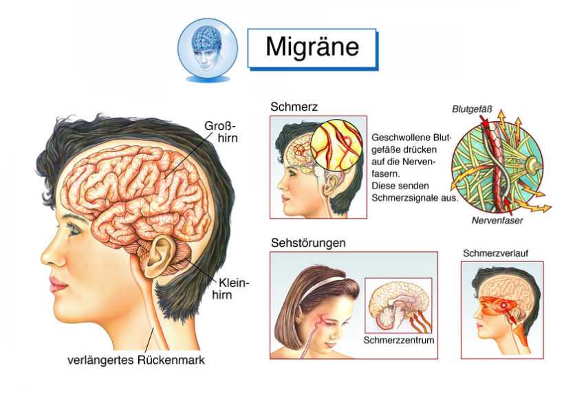 Migräne - Ursachen, Symptome Und Behandlung (mit Videos)