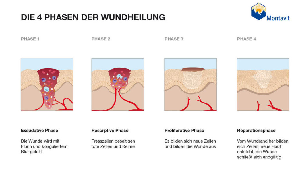 Wundschmerzen - Ursachen, Arten Und Behandlung